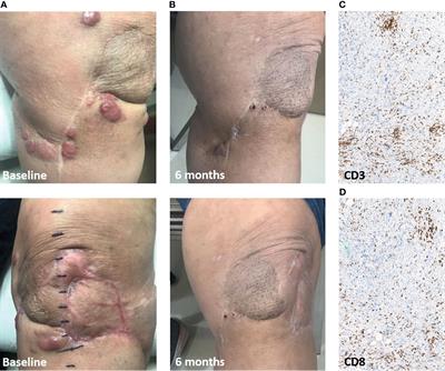 Case Report: Response to Regional Melphalan via Limb Infusion and Systemic PD1 Blockade in Recurrent Myxofibrosarcoma: A Report of 2 Cases